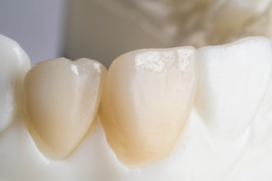 UTZirc 100% Zirconia